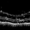 Siloton’s first OCT image of Rowe Technical Design OCT Model Eye retina tissue phantom, acquired using a photonic chip.